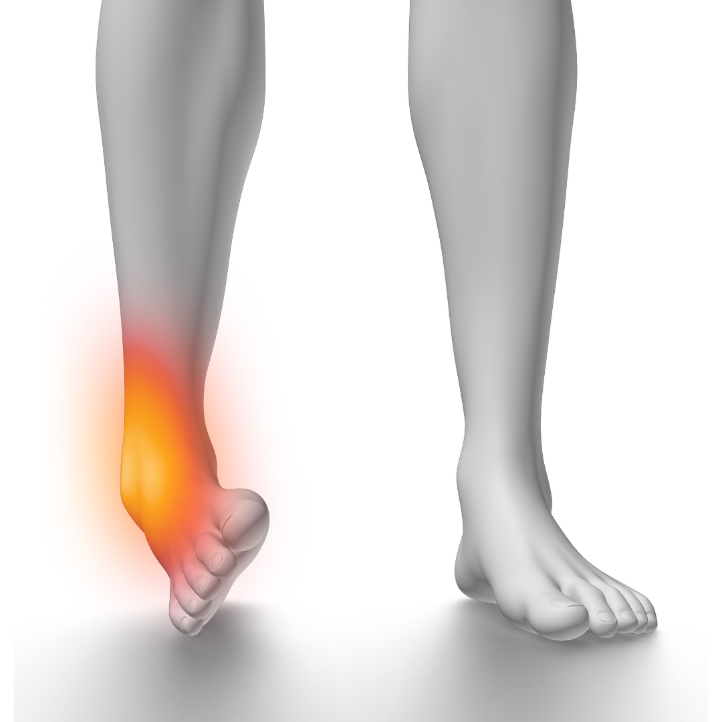 Lateral Ankle Sprain – Osteopath's can help - The Osteopath